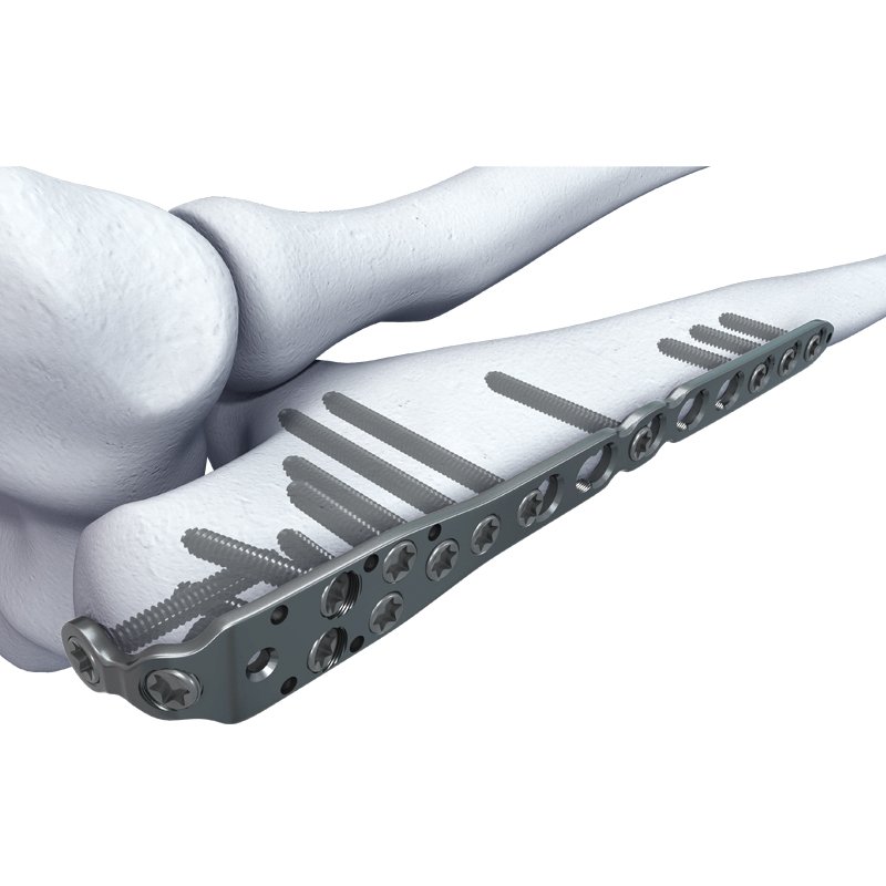 Ulna and Radius Locking Plates